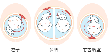 逆子 多胎 前置胎盤