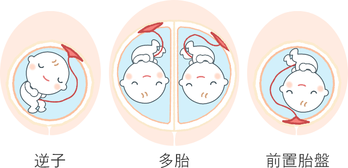逆子 多胎 前置胎盤